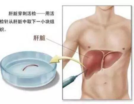 红细胞寿命测定在间接胆红素升高原因判断中的应用5