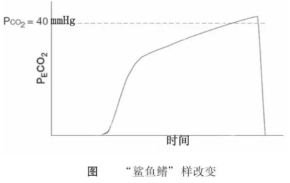 急诊应用呼气末二氧化碳监测，你需要了解这些！1