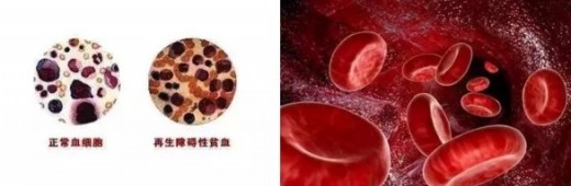 红细胞寿命测定在再生障碍性贫血诊疗中的应用
